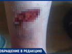 В Волжском 8-летней девочке зашивали ногу после укуса бездомной собаки