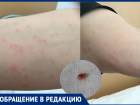Клопы «атаковали» пациентов больницы им. Фишера в Волжском