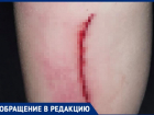 Ребенок распорол ногу на детской площадке в Волжском