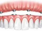 All on 4 - Имплантация и протезирование зубов