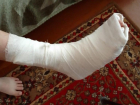 10-летний мальчик сломал ногу на детской площадке под Волжским