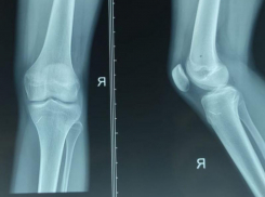 4 года ребенок жил с иглами в ноге из-за страха признаться родителям: волжане, будьте внимательней к детям