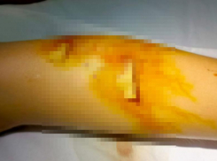 Волжане требуют наказания для владельца собаки, напавшей на ребенка