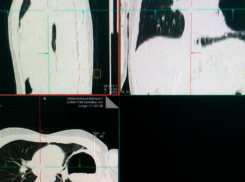 Проба Манту спасла жизнь 13-летнему подростку из Волгограда