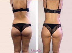 До -10 см за курс в Shikardos без диет и тренировок!