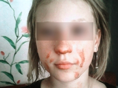 На западе Волгограда 10-летняя школьница обожгла лицо, чтобы впечатлить сверстников