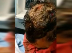 Волжанин с головой полной червей обратился к медикам