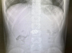 В Волгограде хирурги извлекли из желудка ребенка 5 рублей 