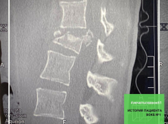 В Волгограде врачи спасли 17-летнюю девушку от инвалидности