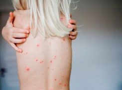 На 33% участились случаи заболевания сифилисом в Волжском