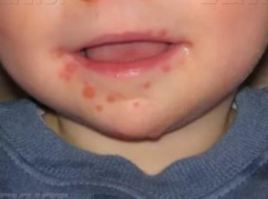 Роспотребнадзор прокомментировал ситуацию с заболеваемостью турецкой лихорадкой Коксаки в Волжском