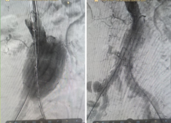 На грани жизни и смерти: волгоградские врачи провели уникальную операцию на аорте