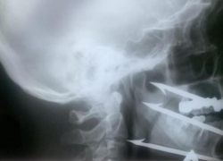 Волгоградские врачи извлекли гарпун из лица рыбака в миллиметре от сонной артерии