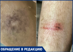 Волжанка показала фото изувеченной дочери после наезда 13-летней девочки на электросамокате