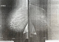 У жительницы Средней Ахтубы вовремя выявили диабет и рак груди