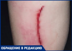 Ребенок распорол ногу на детской площадке в Волжском