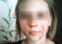 На западе Волгограда 10-летняя школьница обожгла лицо, чтобы впечатлить сверстников