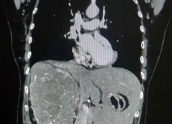 Волгоградские врачи провели сложную операцию и удалили гигантскую опухоль