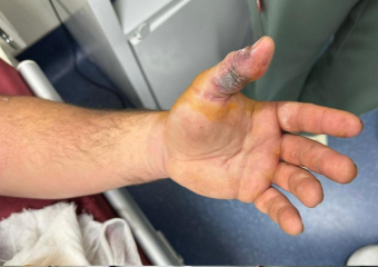 В Волгоградской области 16 человек чуть не лишись жизни от укусов гадюк