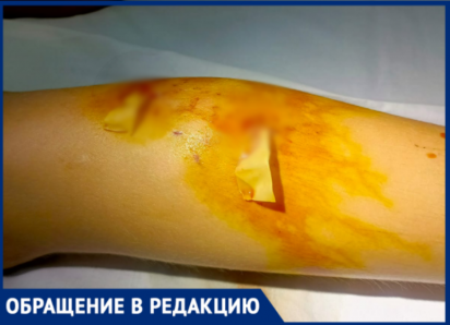 «Бросили ребенка, не оказав помощи»: волжанка ищет свидетелей нападения собаки на ее сына