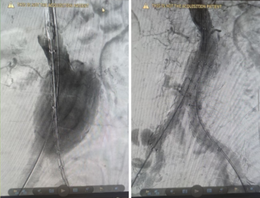 На грани жизни и смерти: волгоградские врачи провели уникальную операцию на аорте