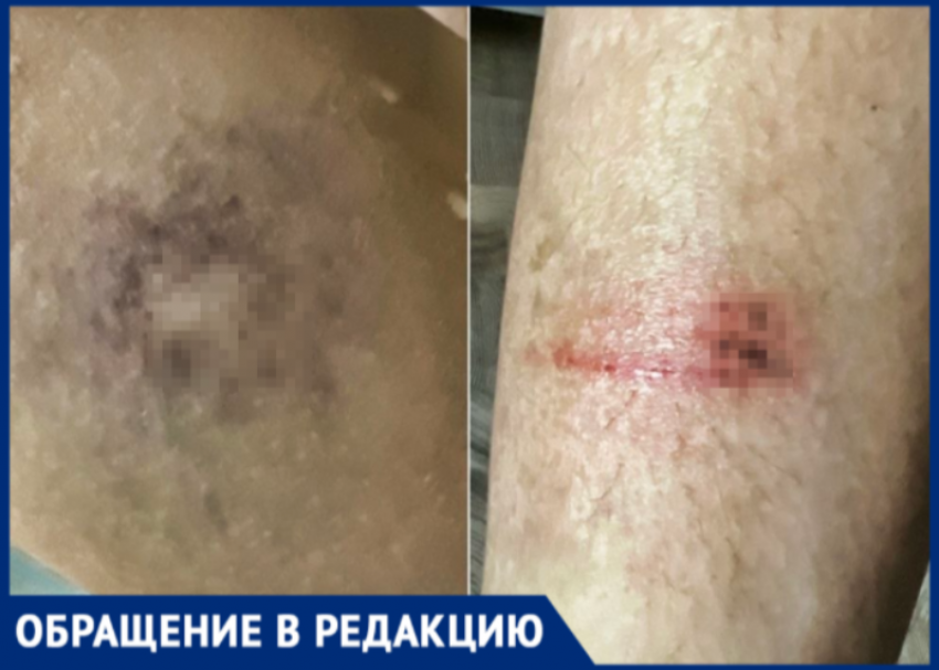 Волжанка показала фото изувеченной дочери после наезда 13-летней девочки на электросамокате