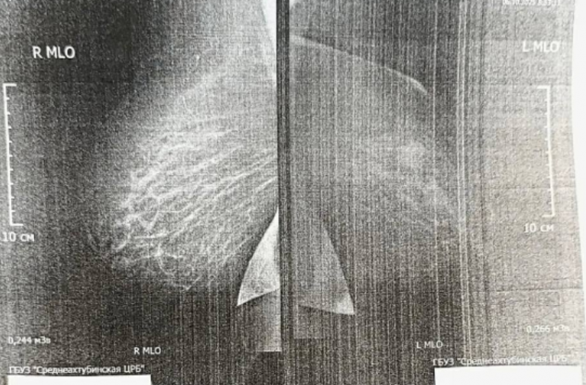 У жительницы Средней Ахтубы вовремя выявили диабет и рак груди