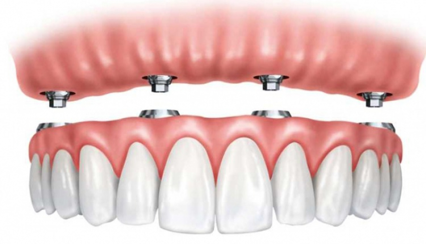 All on 4 - Имплантация и протезирование зубов