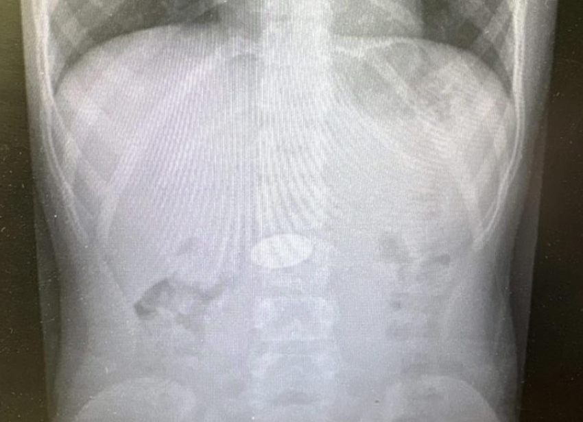 В Волгограде хирурги извлекли из желудка ребенка 5 рублей 