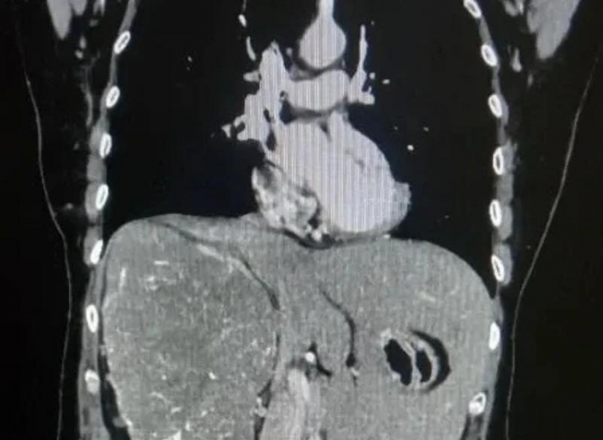 Волгоградские врачи провели сложную операцию и удалили гигантскую опухоль